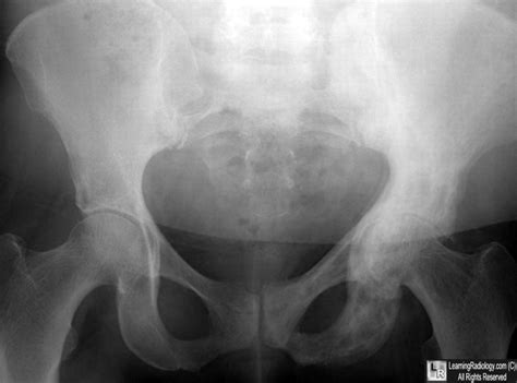 Learning Radiology - paget, disease, paget's, pelvis