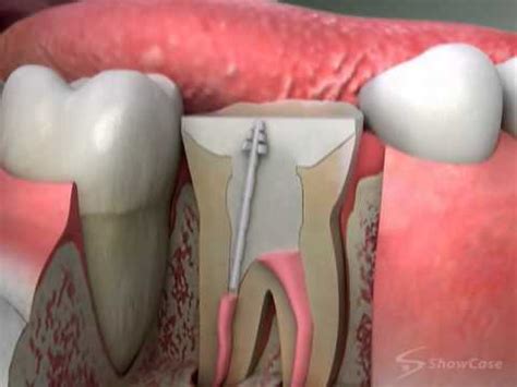 Crowns Post and Core Procedure - YouTube