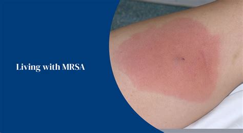 Mrsa Rash On Legs