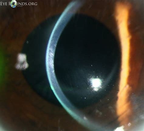 Vogt's striae in keratoconus