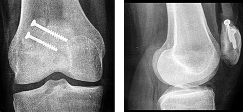 Bipartite Patella - Pediatrics - Orthobullets