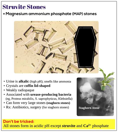 Struvite stones - Medicine Keys for MRCPs