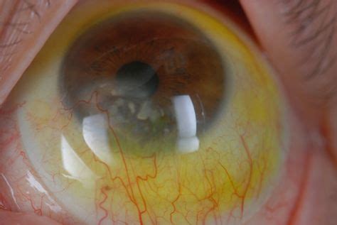 This patient has ocular cicatricial pemphigoid, an ocular manifestation of a systemic autoimmune ...