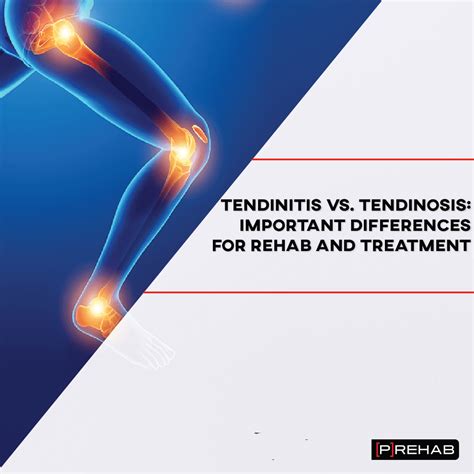 Tendinitis Exercises and Understanding Different Tendon Injuries