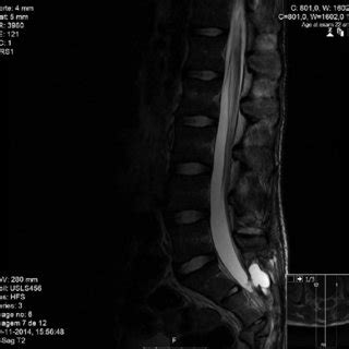 Lumbosacral MRI demonstrating post-traumatic meningocele in sagittal view. | Download Scientific ...