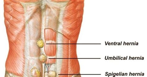 Spigelian Hernia Symptoms, Diagnosis, Treatment