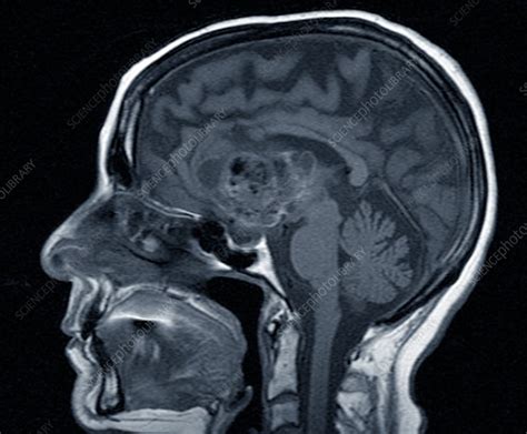 Astrocytoma brain cancer, MRI scan - Stock Image - C037/0759 - Science Photo Library