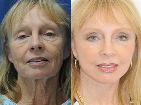 Facelift Plastic Surgeon in Beverly Hills | Dr. Renato Calabria