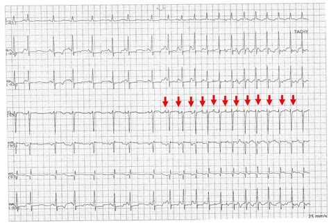 ECG Channel: Atrial Tachycardia