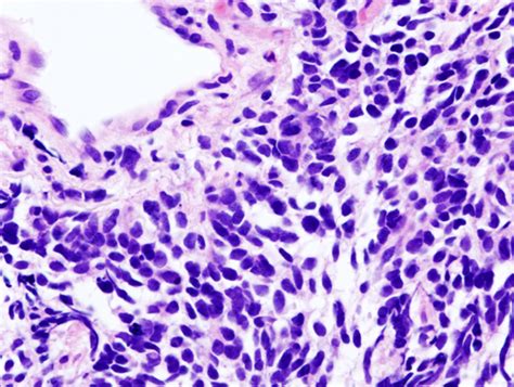 Benign Mesothelioma: Lung Cancer (Small-Cell Lung Carcinoma, Metastasis)