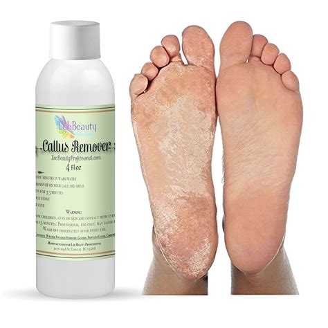 Best Callus Remover.Callus Eliminator,Liquid & Gel For Corn And Callus ...