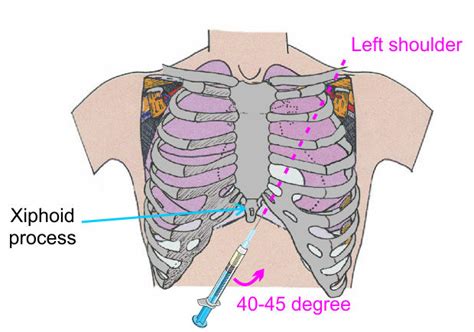 Clinical Pericardiocentesis