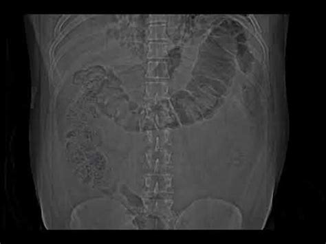 Colon Cut off Sign || Acute Pancreatitis - YouTube