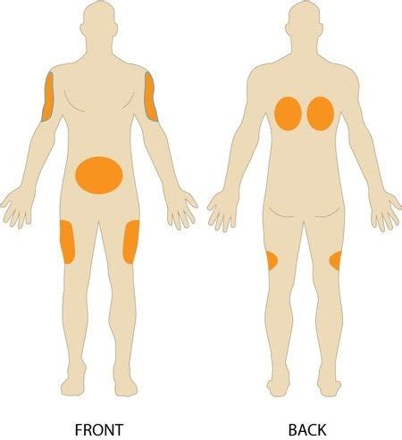 How to Perform a Subcutaneous Injection of Vitamin B12 | Subcutaneous injection, Injections ...