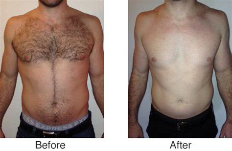 Before & After Images of LaserAway Treatments | LaserAway | Chest hair ...