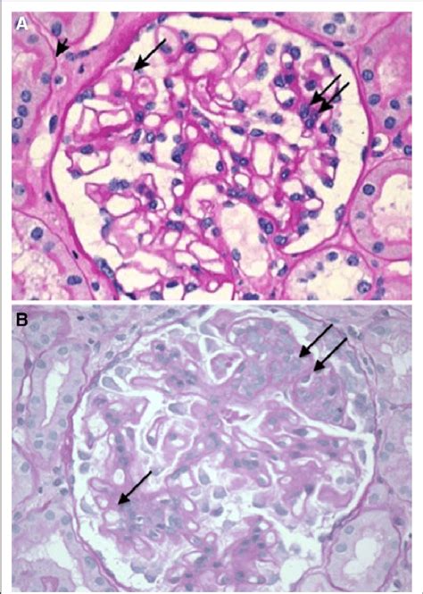 Initial glomerular histology. A, Normal glomerulus. Single arrow:... | Download Scientific Diagram