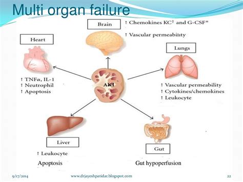 Multi organ dysfunction syndrome