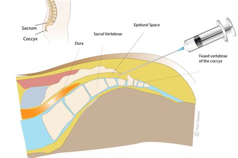 Caudal Epidural Injections – Rajiv Bajekal