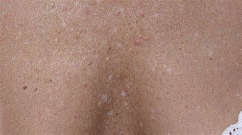 White Spots on Skin: Causes, Treatments, & Prevention