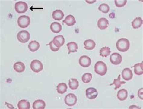 Hypochromia | Medical Laboratories