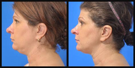 CoolSculpting for Double Chin - Dr. Dean Kane Center for Cosmetic Surgery & MediSpa