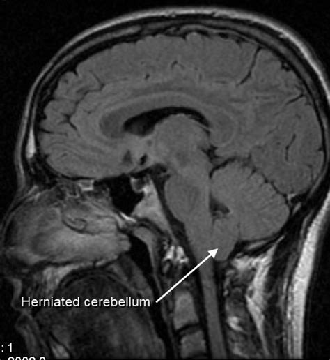 File:MRI of human brain with type-1 Arnold-Chiari malformation and herniated cerebellum.jpg ...