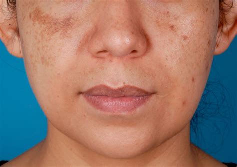 Hyperpigmentation | Melasma Reston, Virginia, Washington DC, Maryland