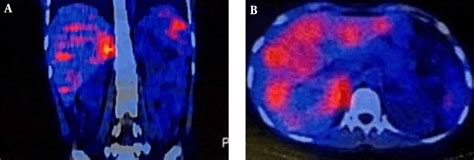 A, Coronal; and B, transverse sections of MIBG SPECT-CT scan showing... | Download Scientific ...