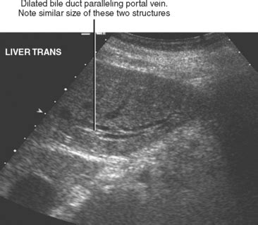 Gallbladder and Bile Ducts | Radiology Key