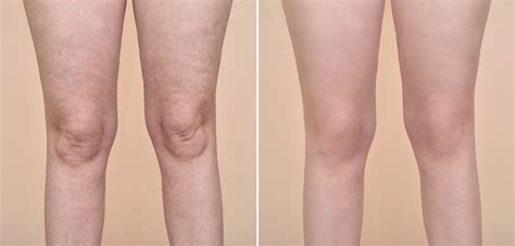 Lipomassage Treatments is a Must After Liposuction – SepiSpa