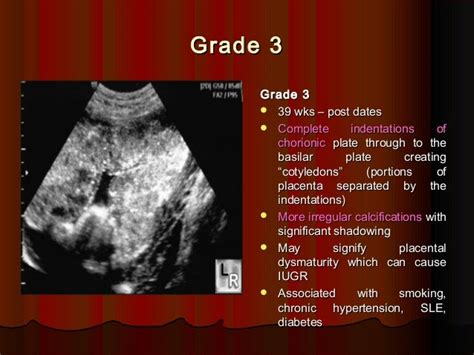 Placenta ultrasound