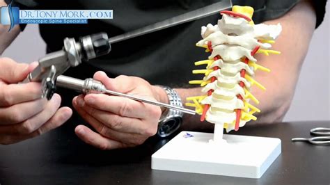 The Ins and Outs of Cervical Spinal Stenosis