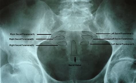 Anteroposterior view of male pelvic radiograph showing sacral hiatus ...