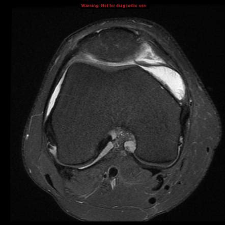 Medial Patellar Plica Syndrome Radiology Reference Article | My XXX Hot ...