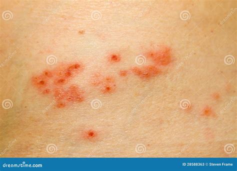 Shingles Rash Stock Photos - Image: 28588363