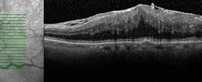 Epiretinal Membrane | Clearview Eye Centre | Calgary