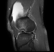 Sulcus Terminalis Lateral Femoral Condyle