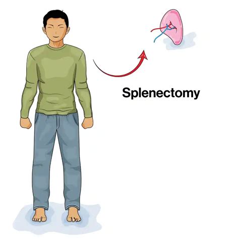 Splenectomy (Spleen Removal) Splenectomy Indications & How Is It Done