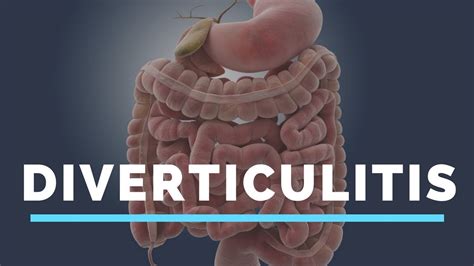 Complications Of Diverticulitis