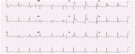 Practice 12-Lead ECG #1