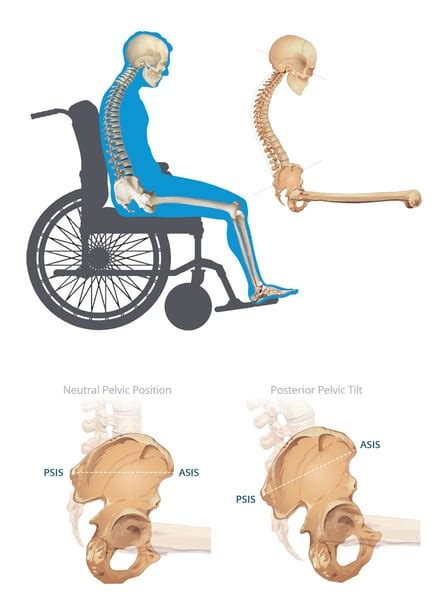 Posterior Pelvic Tilt: The Correction of Sacral Sitting