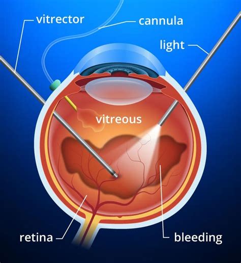 Vitrektomi Nedir? | Dr. Özgür Yaşar