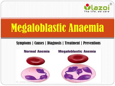 PPT - Megaloblastic Anaemia: Symptoms, causes, diagnosis, treatment and ...