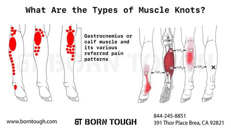 Calf Muscle Knots - All You Need to Know About These Painful Lumps! – Born Tough