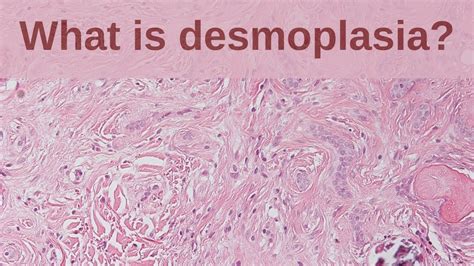 What is Desmoplasia? - Pathology mini tutorial - YouTube