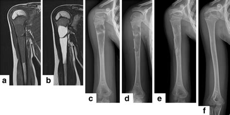 Simple Bone Cyst Humerus