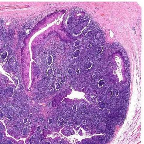 Lingual Tonsils Histology