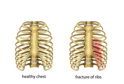 Rib Fracture & Fixation from Trauma - International Centre for Thoracic ...