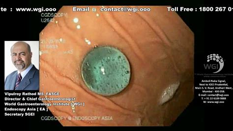 Endoscopic procedure for foreign body removal - YouTube