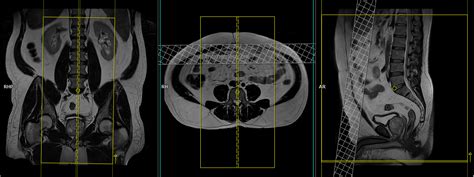 Lumbosacral Plexus MRI Protocols and Planning | Indications for MRI ...